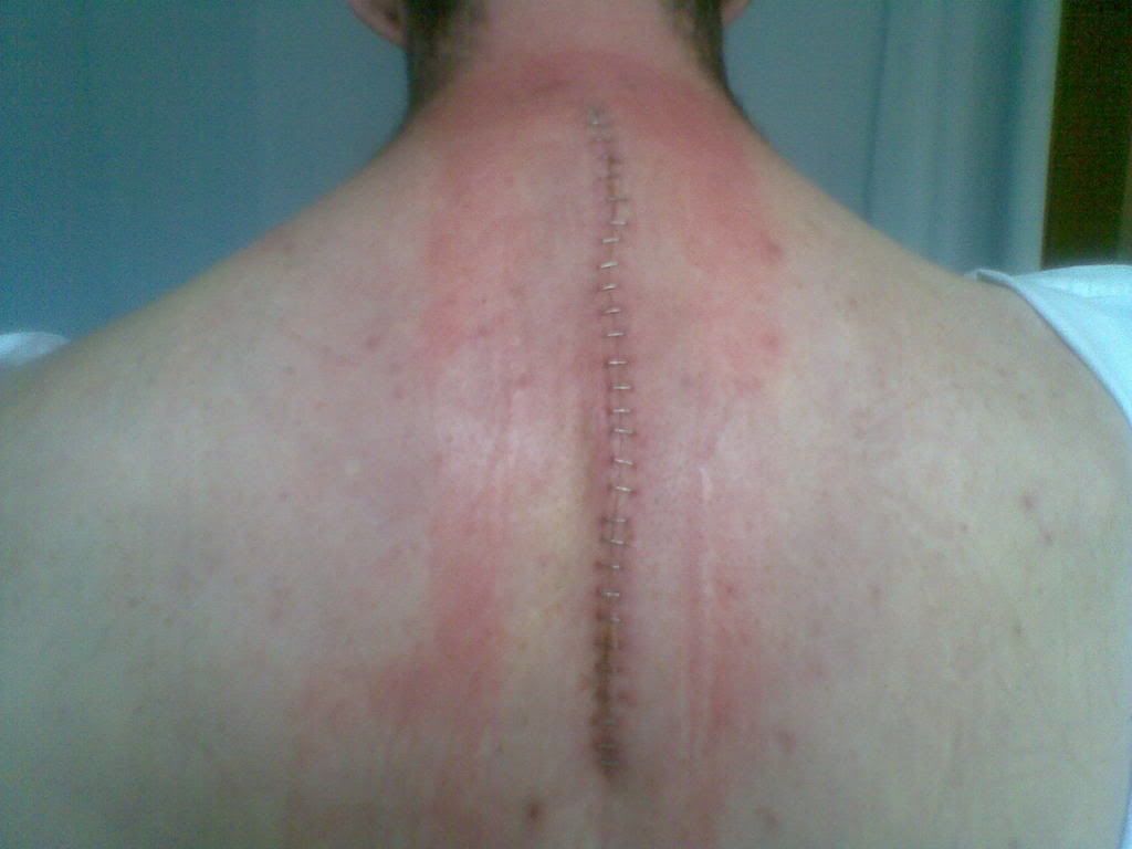 Tims Axe Wound Photo by tommyboy7777 Photobucket